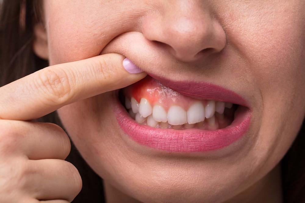 Gum Disease Warning Signs